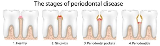 Periodontitis-1