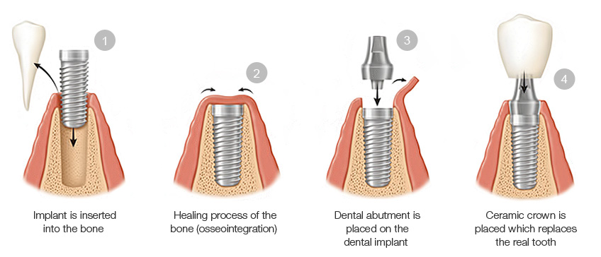 Dental Implant procedure