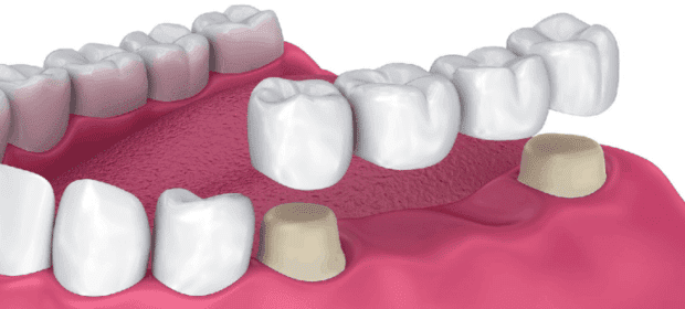 dental bridge cost in india