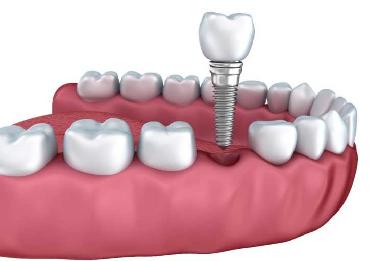Dental Implants Treatment Planning
