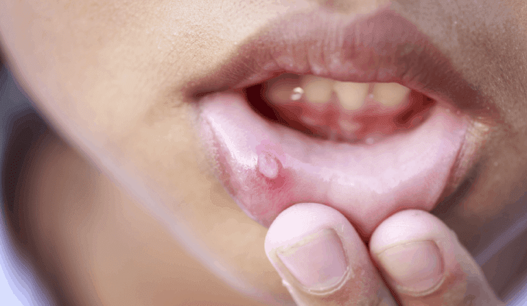 Mouth-ulcers