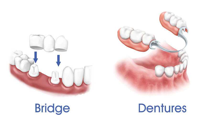 Partial Dentures Front Teeth