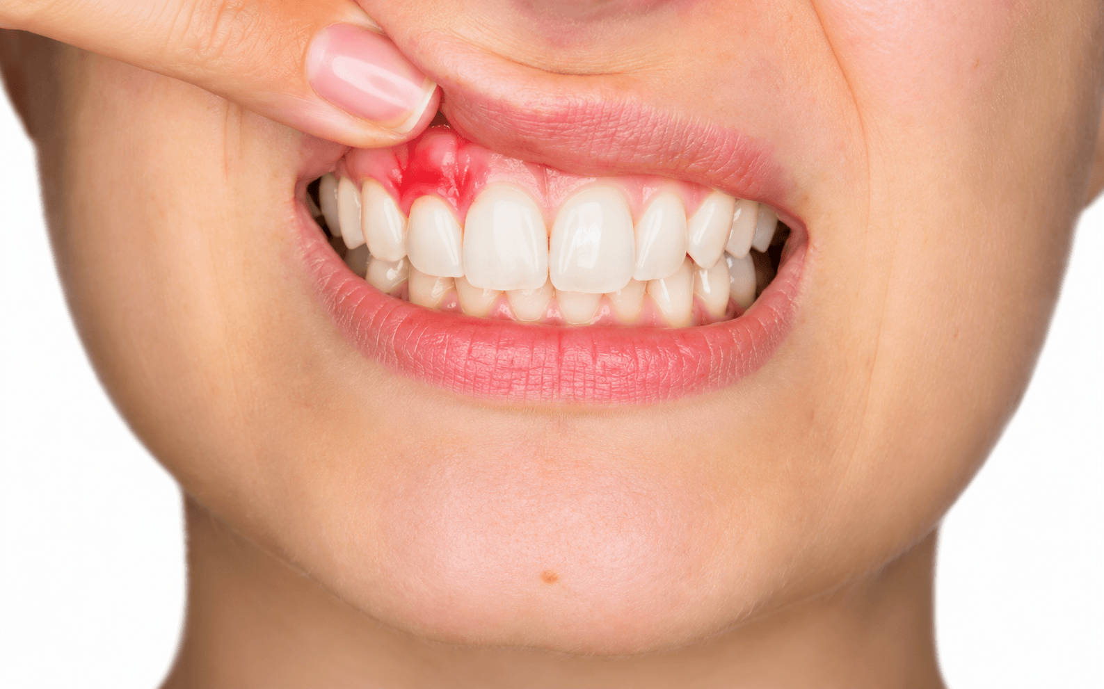 stress and oral health gum disease