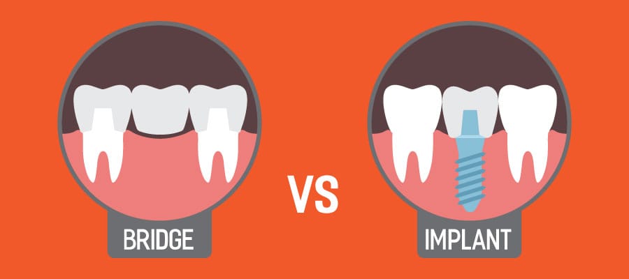 Dental Implants Vs Bridges How To Know Whats Best For You