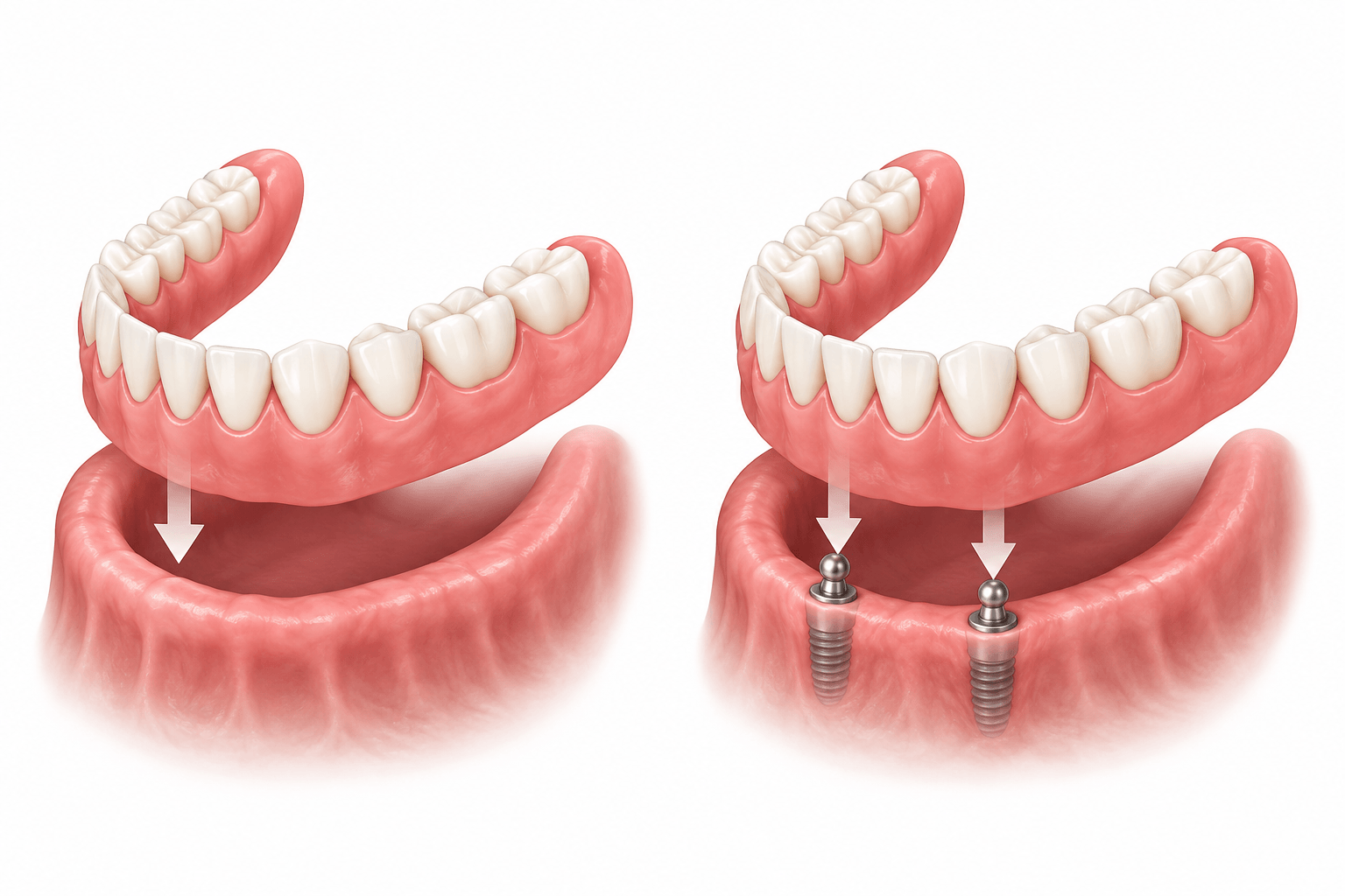 conventional dentures