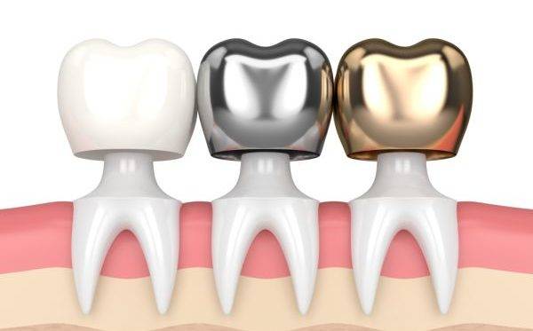 types of crown