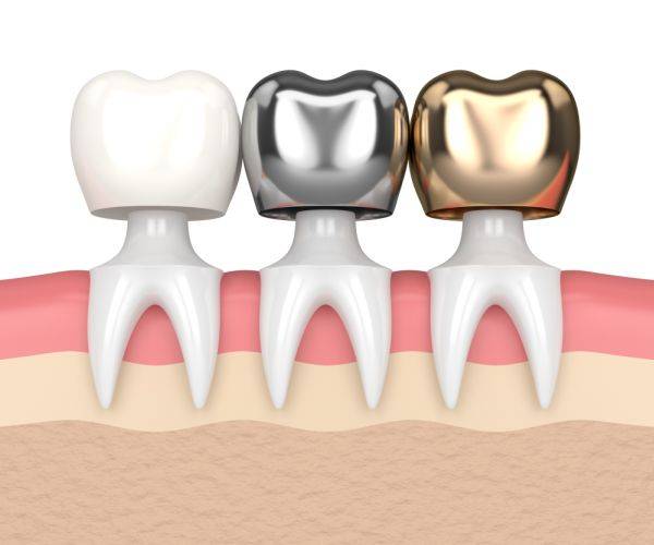 How can Dental Crowns support you? | Dental Crowns | Sabka Dentist
