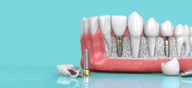 dental implants treatment in Thane