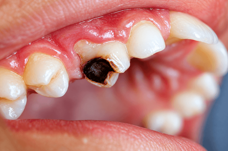 tooth-cavity
