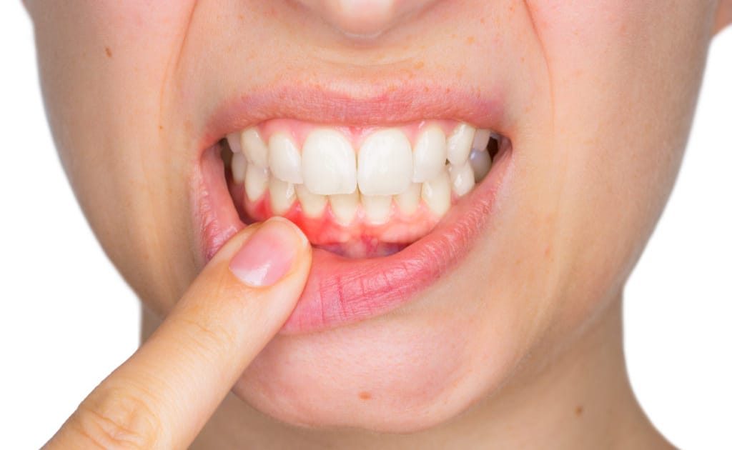 Cause_Bleeding_Gums