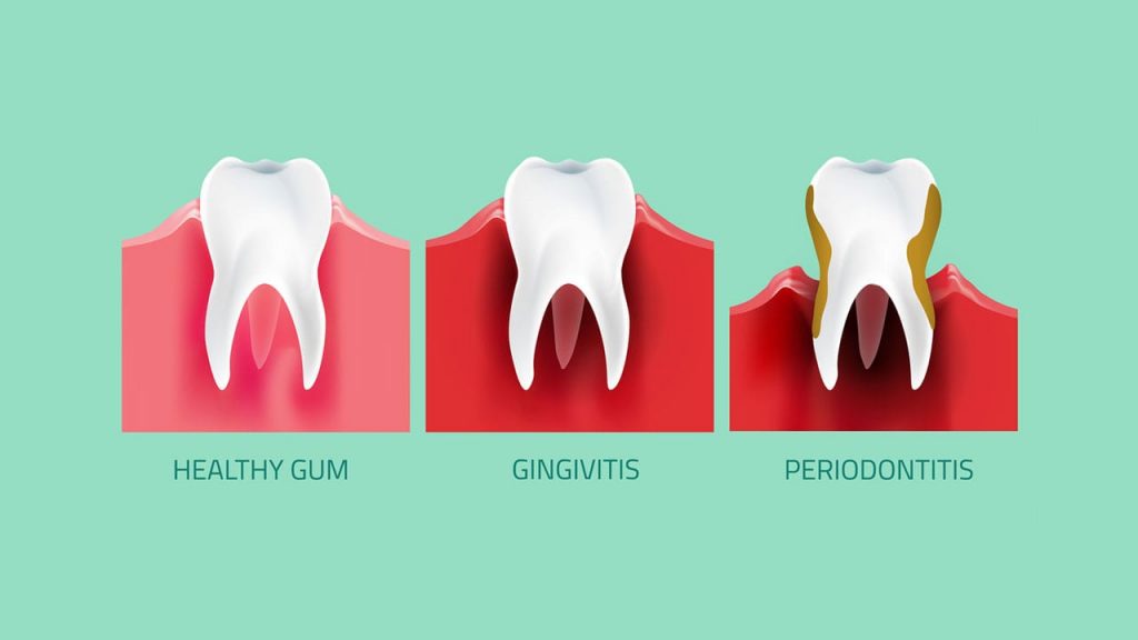 gum-disease-graphic-min