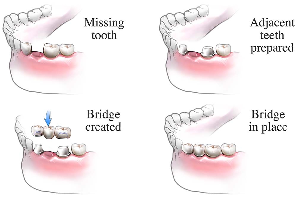 dental-bridge-procedure