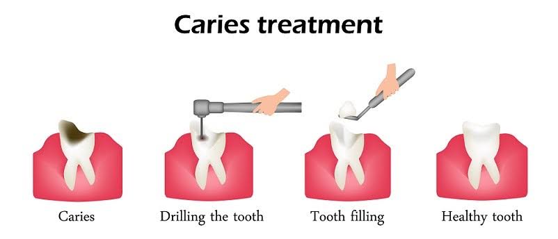 types of tooth fillings