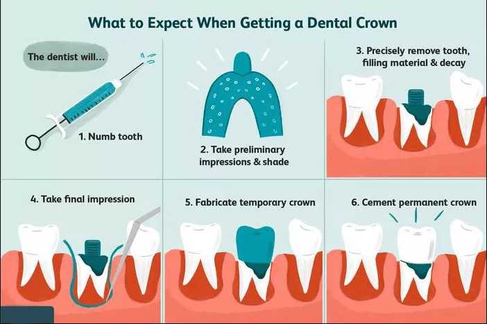 Dental Crown Cost In Pune Near Me Tooth Cap Price In Pune