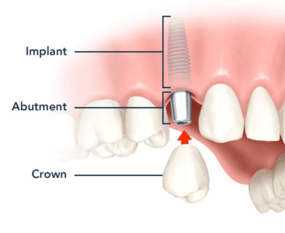 Why do I think about dental implants? – Sabka Dentist – Top Dental ...