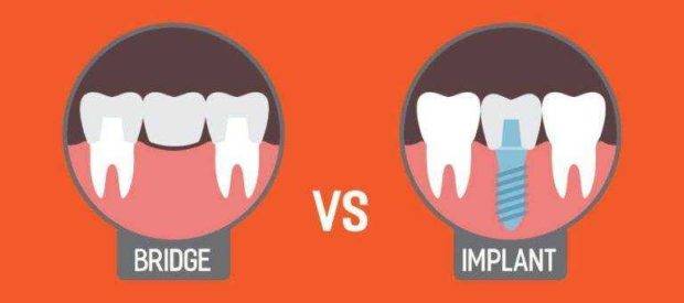 Implants Vs bridges