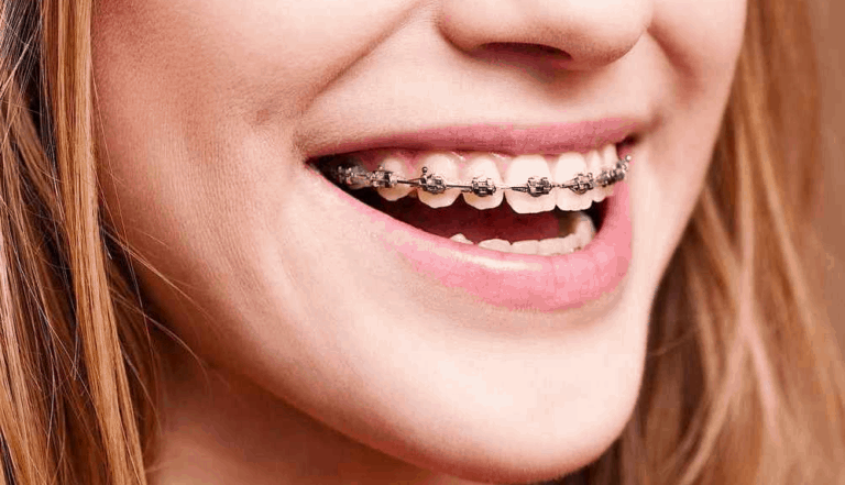 How to Choose the Right Braces for You