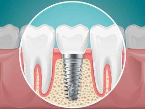 dental-implants-in-7-bungalow-andheri