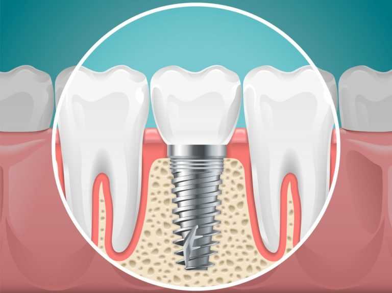 dental-implants-benefits