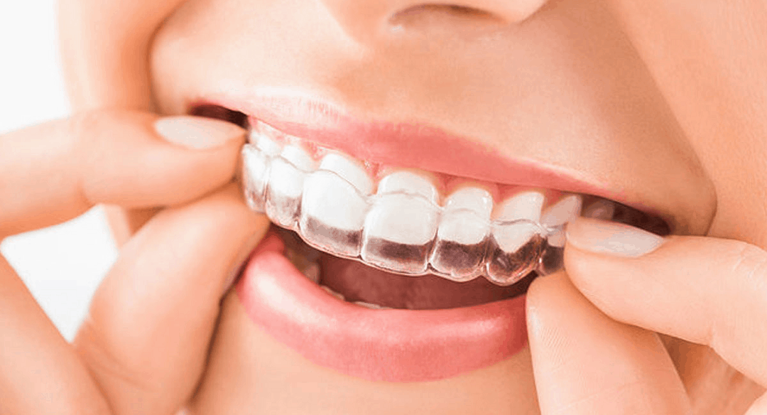 invisalign braces