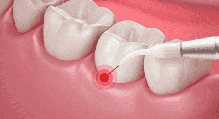 laser-scaling-of-teeth
