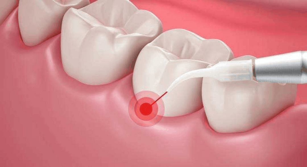 How laser scaling of teeth can benefit you?