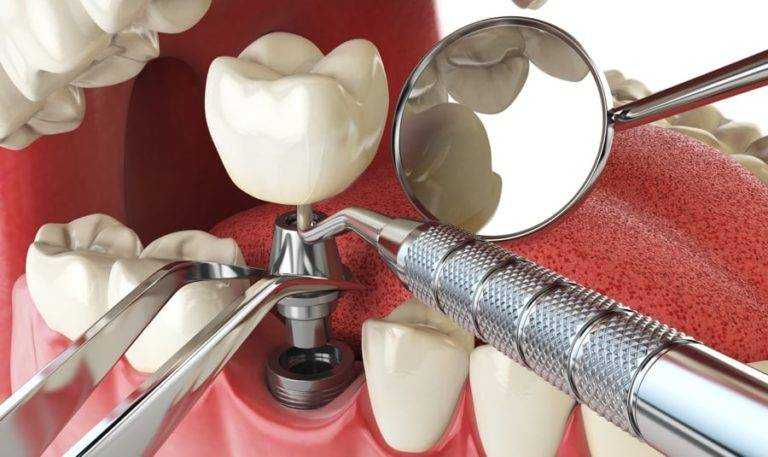 Dental-Implant-types