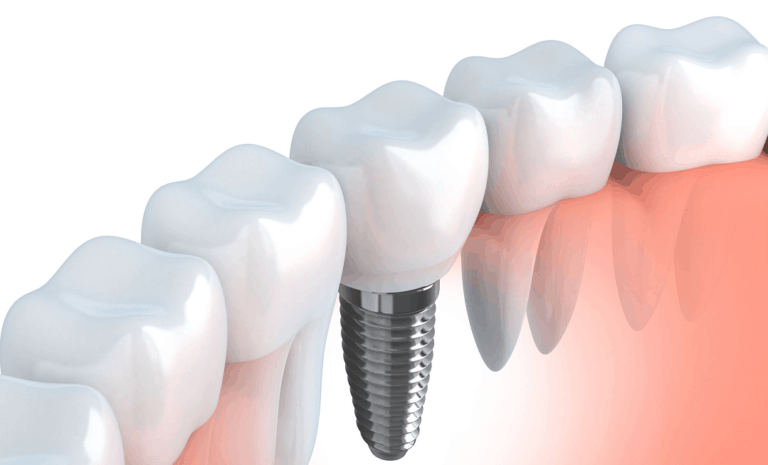 How safe are Dental Implants and Teeth Implants?
