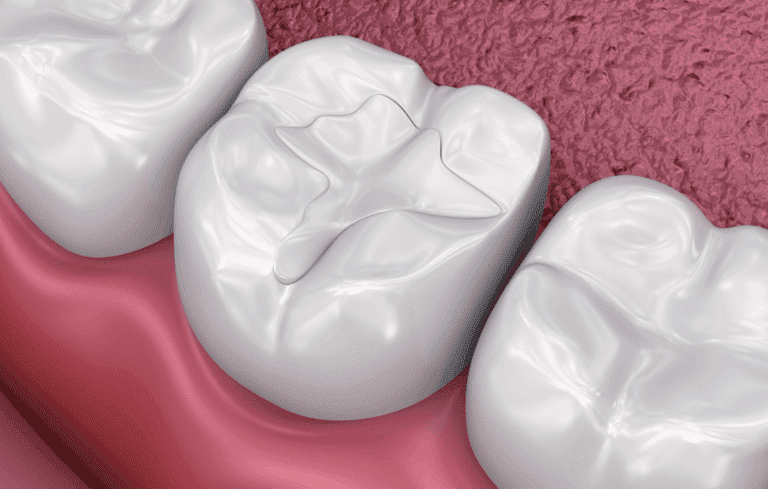benefits-of-dental-sealant