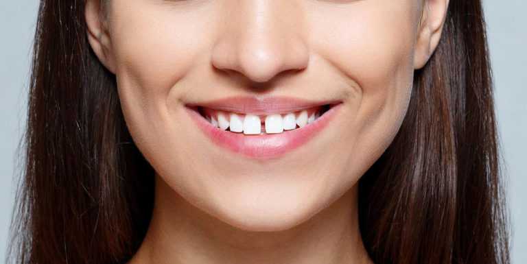 How To Fix Gap In Front Teeth Without Braces