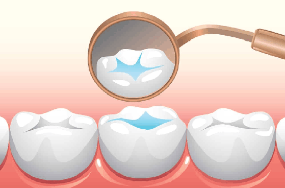 pit and fissure sealants