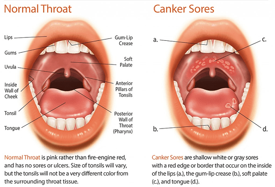 canker sore on soft palate