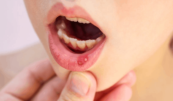 canker sores