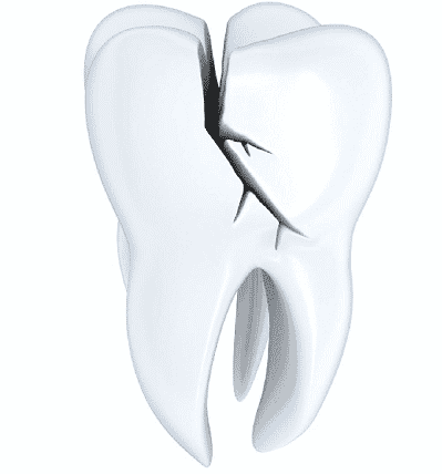 cracked-tooth