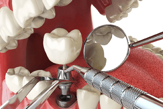 dental implants