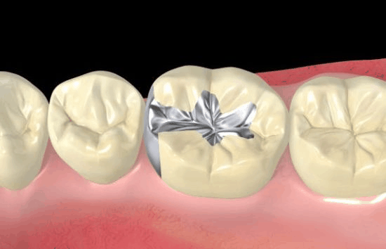 Dental Sealants