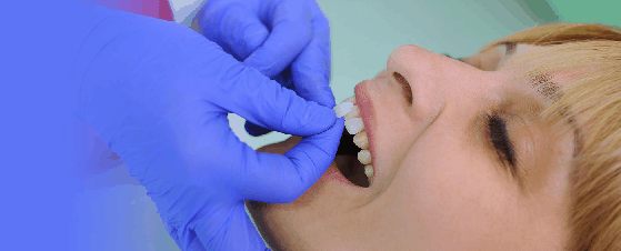 dental veneer