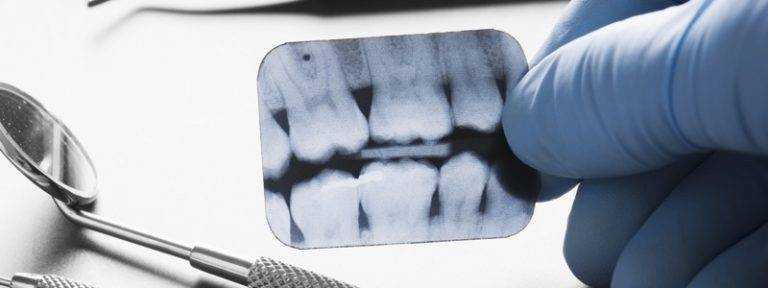 Ever Wonder Why Dentist S Take X Rays