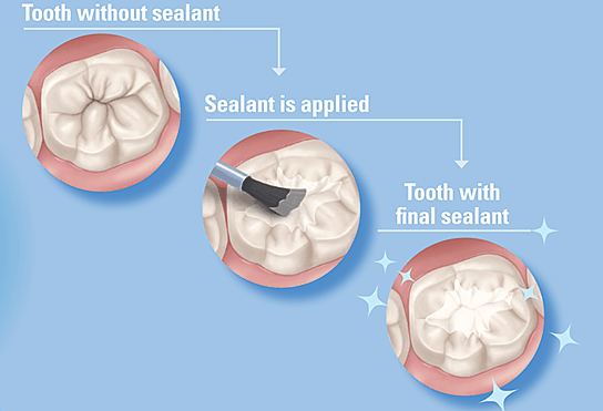 Dental Sealants