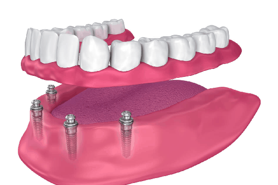 overdenture