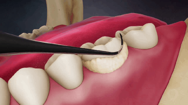 scaling of teeth