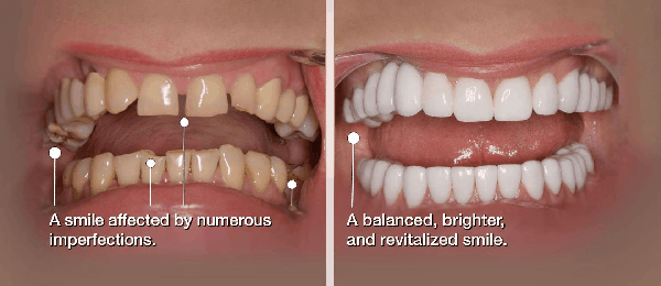 smile makeover to correct your smile