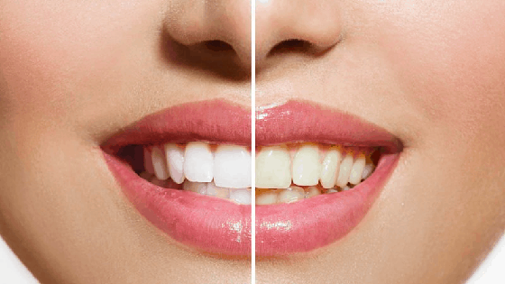 Best Teeth Whitening Treatment Near Me