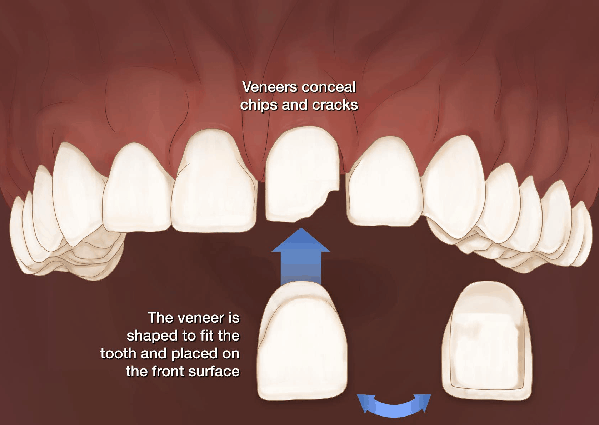 dental veneer