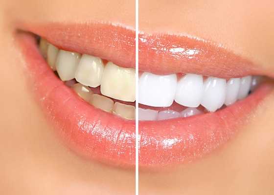 teeth polishing treatment