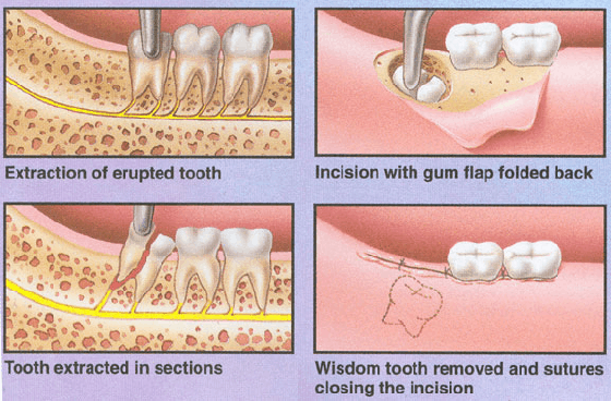 broken wisdom tooth extraction cost