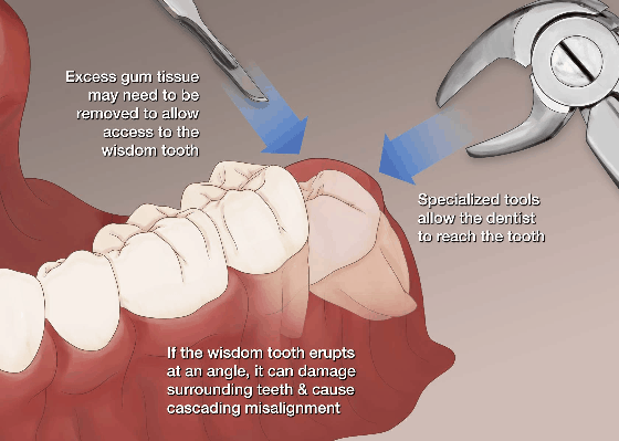 wisdom tooth treatment