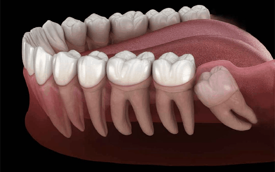 Wisdom Tooth Extraction – Sabka Dentist – Top Dental Clinic Chain In India