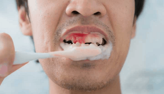 Bleeding-gums-while-brushing-teeth
