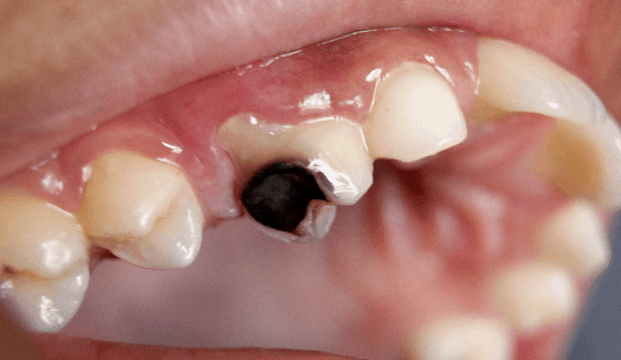 Diabetes and teeth problem